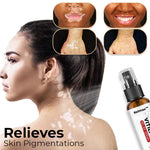 Spray apaisant Kolmax™ Vitiligo